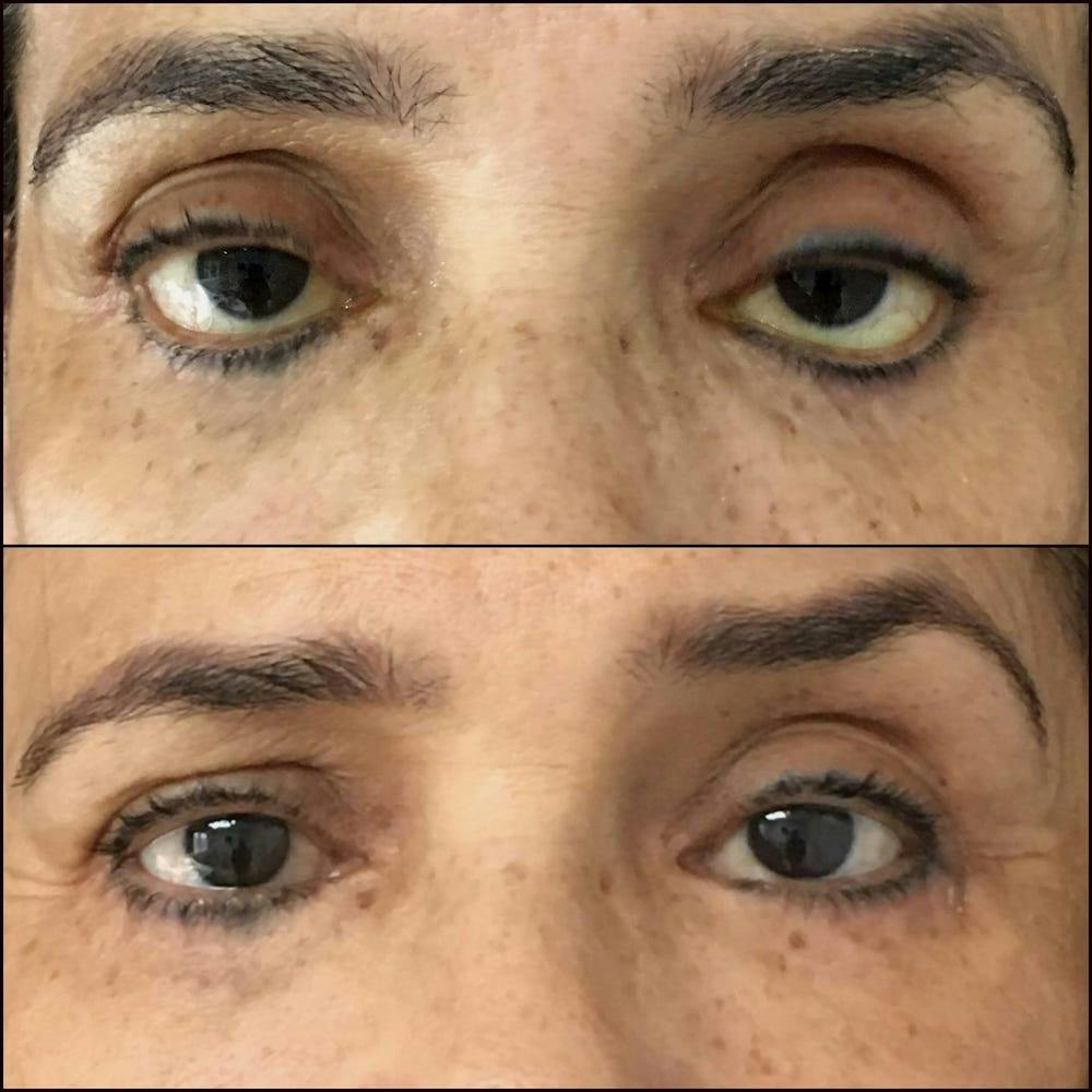 Revision Blepharoplasty