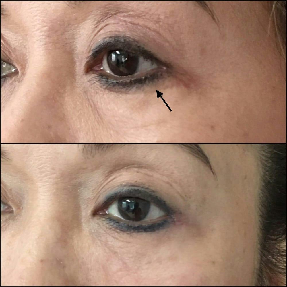 Revision Blepharoplasty