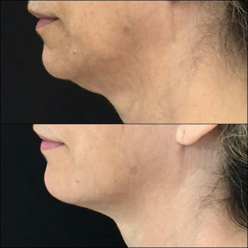 Submental Liposuction Before & After Gallery - Patient 53820294 - Image 2