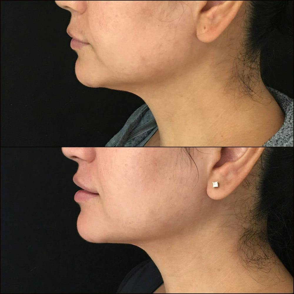 Submental Liposuction Before & After Gallery - Patient 53820295 - Image 1