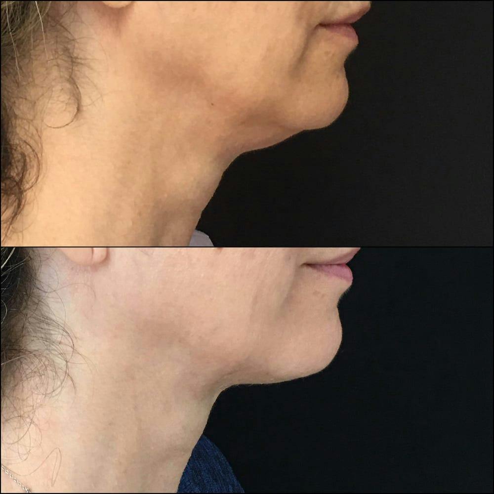 Submental Liposuction Before & After Gallery - Patient 53820294 - Image 1