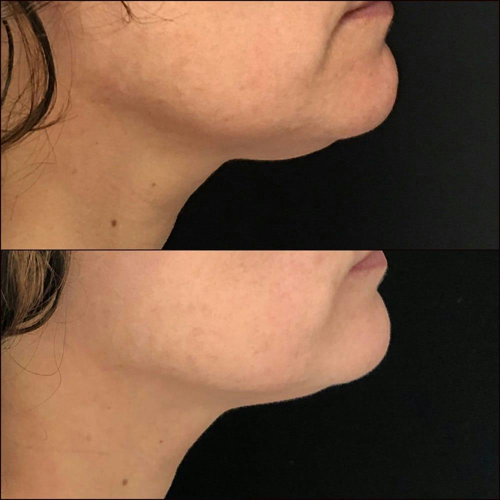 Submental Liposuction Before & After Gallery - Patient 53820296 - Image 1