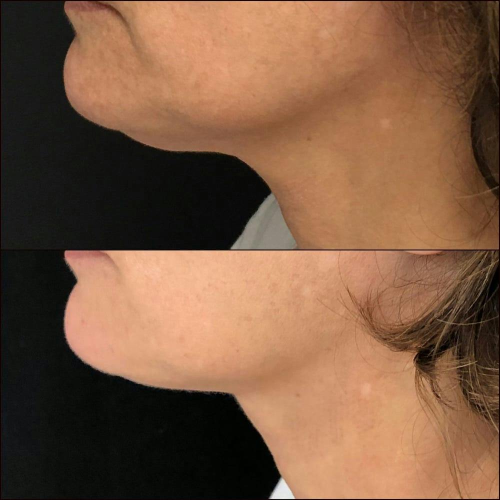 Submental Liposuction Before & After Gallery - Patient 53820296 - Image 2