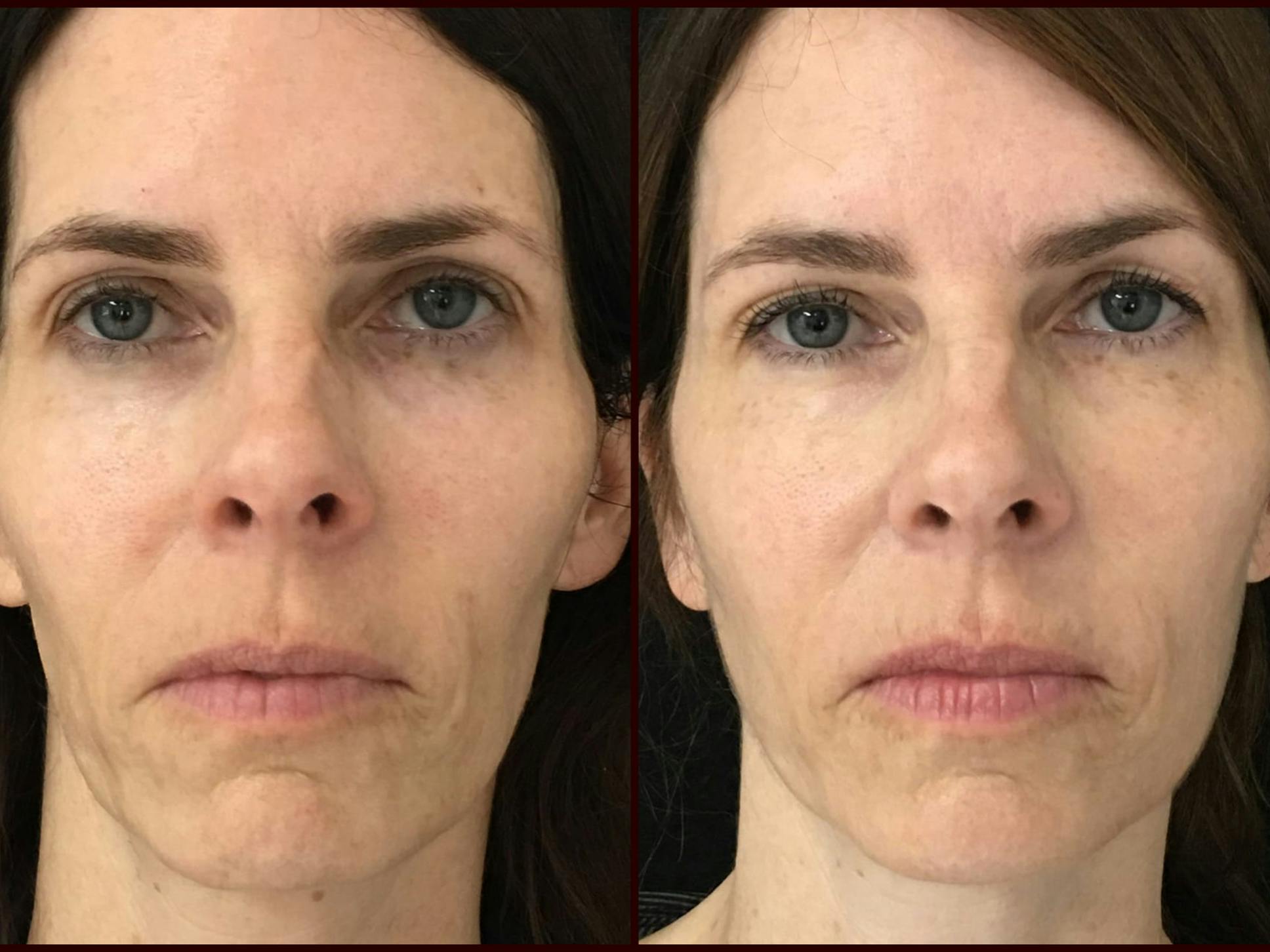 Dermal Fillers Before & After Gallery - Patient 53591928 - Image 1