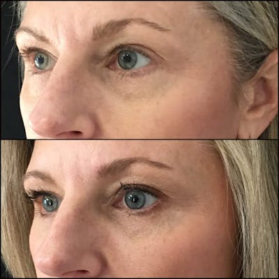 Eyelid Filler Before & After Gallery - Patient 54031162 - Image 1