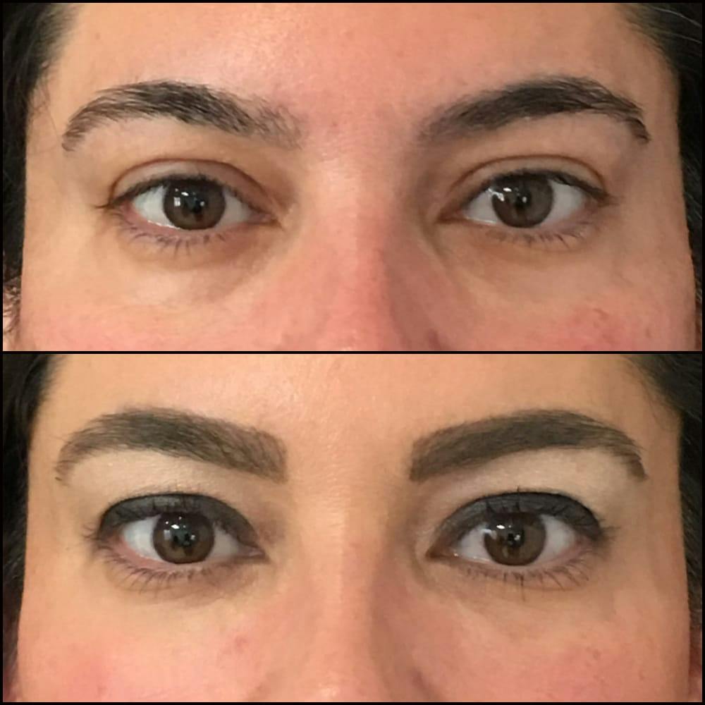 Eyelid Filler Before & After Gallery - Patient 54031163 - Image 1