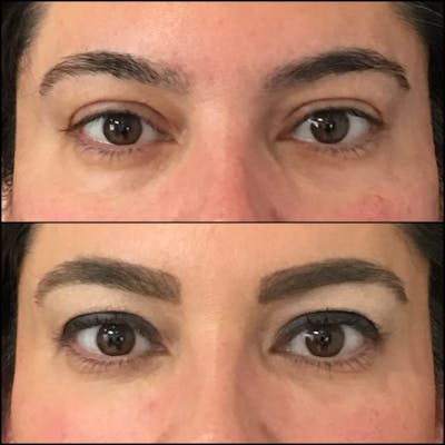Eyelid Filler Before & After Gallery - Patient 54031163 - Image 1