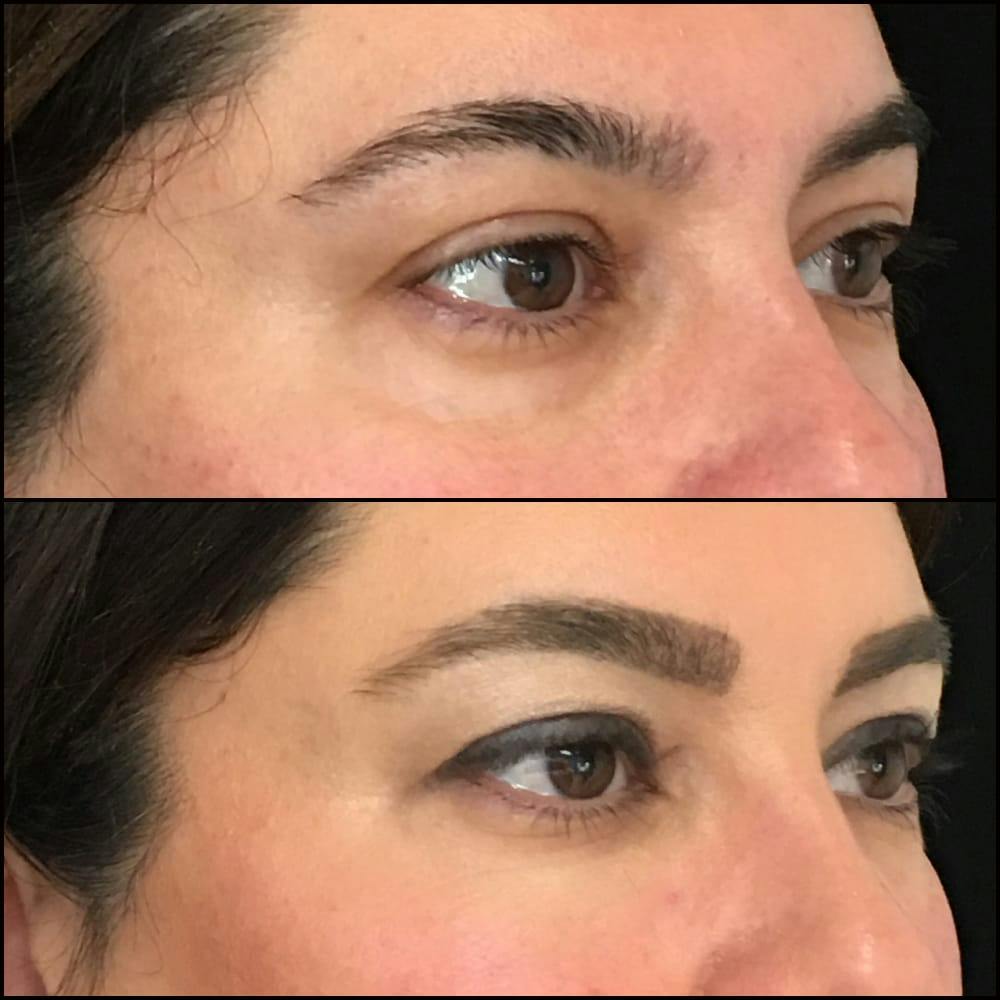 Eyelid Filler Before & After Gallery - Patient 54031163 - Image 2