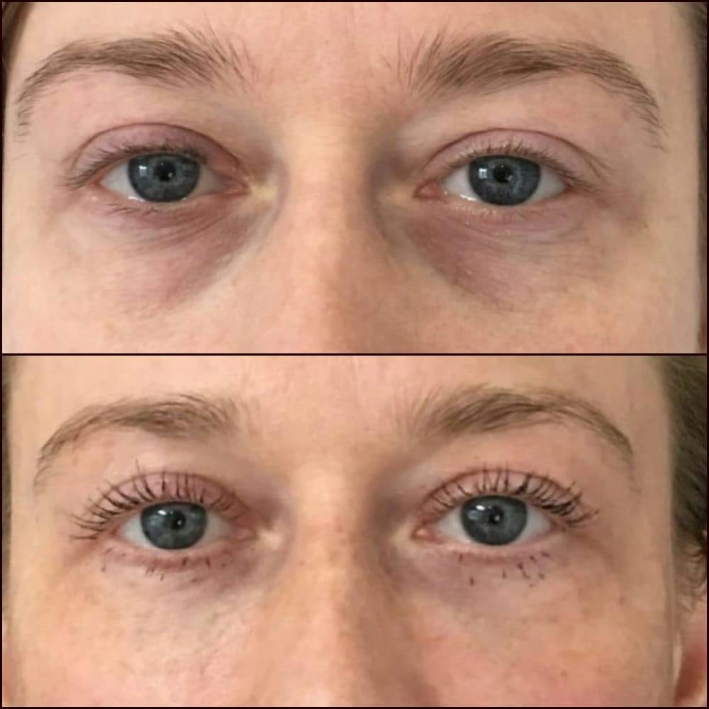 Eyelid Filler Before & After Gallery - Patient 54031166 - Image 1