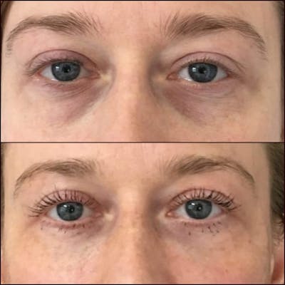 Eyelid Filler Before & After Gallery - Patient 54031166 - Image 1