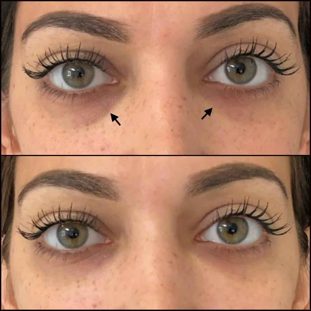 Eyelid Filler Before & After Gallery - Patient 54031167 - Image 1