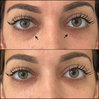 Eyelid Filler Before & After Gallery - Patient 54031167 - Image 1