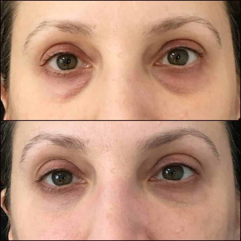 Eyelid Filler Before & After Gallery - Patient 54031169 - Image 1
