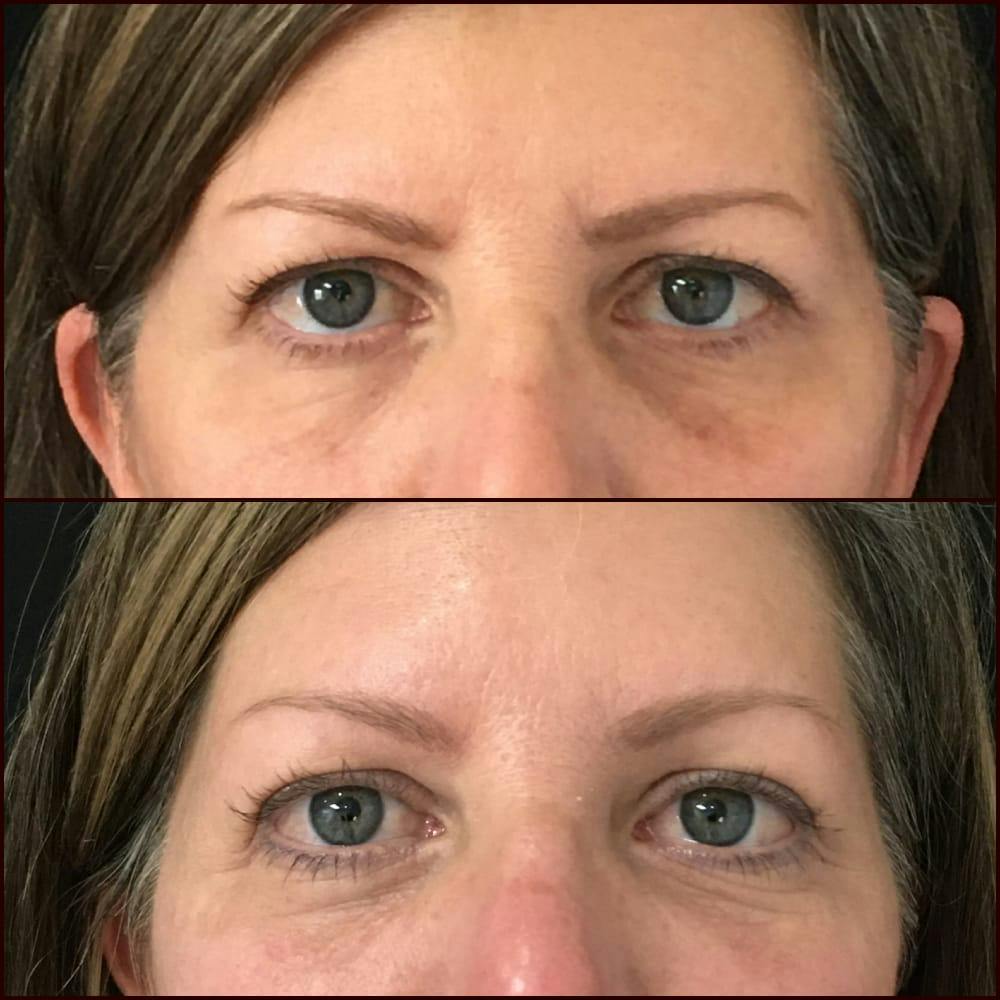 Eyelid Filler Before & After Gallery - Patient 54031170 - Image 1