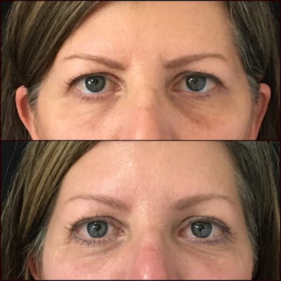 Eyelid Filler Before & After Gallery - Patient 54031170 - Image 1