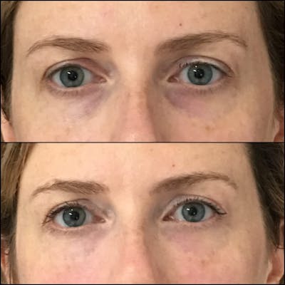 Eyelid Filler Before & After Gallery - Patient 54031172 - Image 1