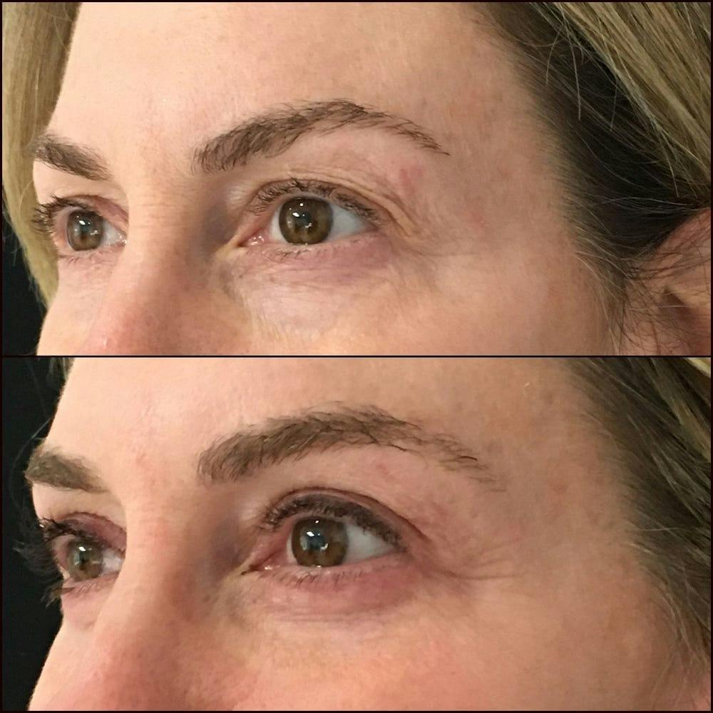Upper Blepharoplasty Before & After Gallery - Patient 54039189 - Image 1