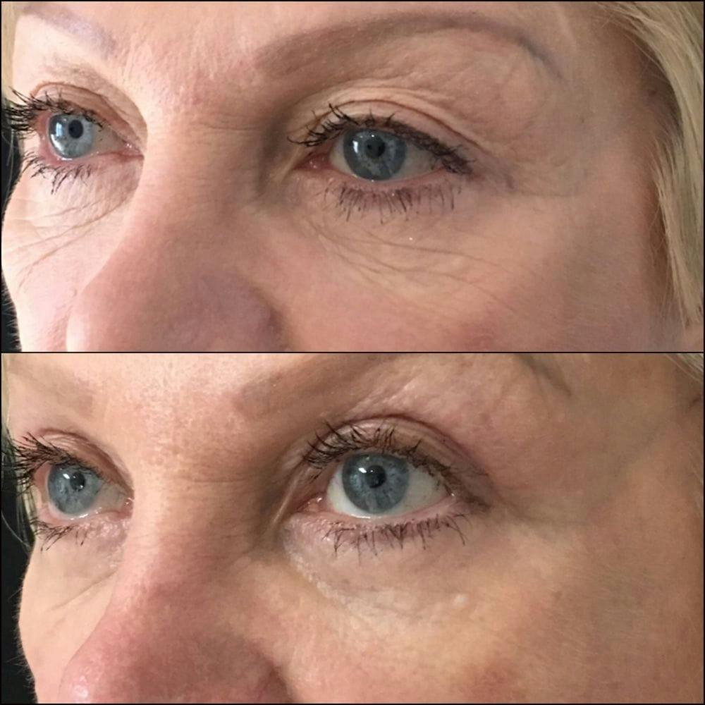 Upper Blepharoplasty Before & After Gallery - Patient 54039190 - Image 1