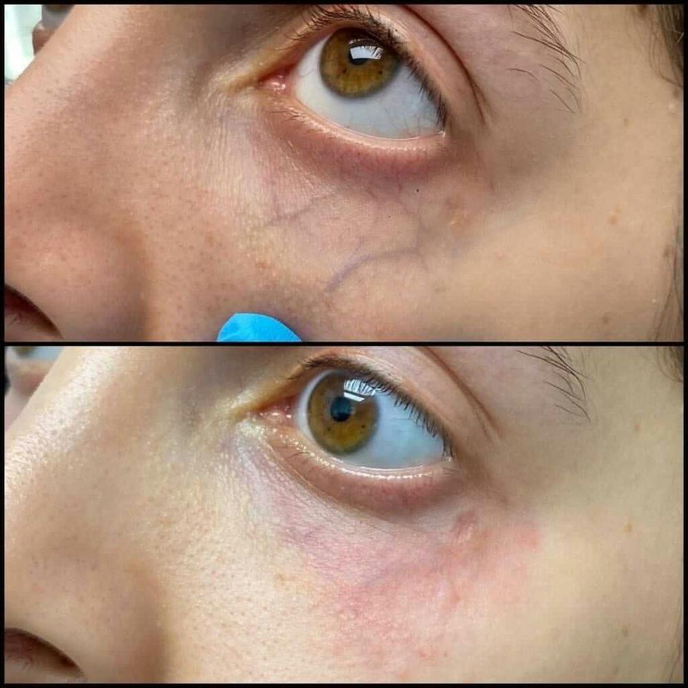 Under Eye Vein Treatment Before & After Gallery - Patient 54039425 - Image 1