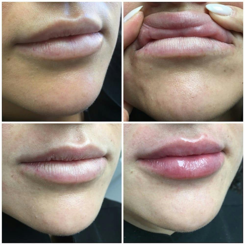 Lip Enhancement Before & After Gallery - Patient 54185598 - Image 1