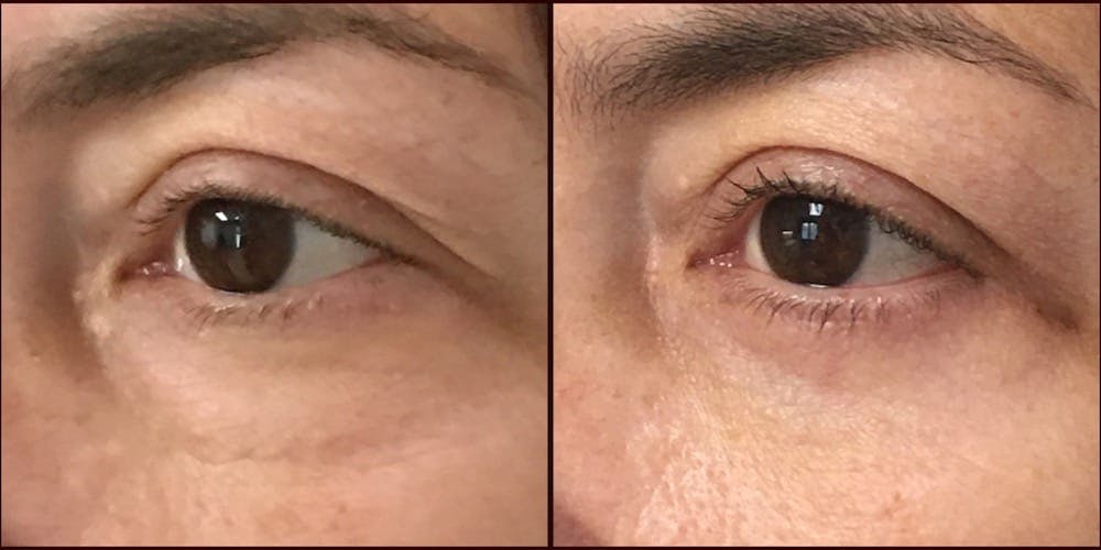 Lower Blepharoplasty Before & After Gallery - Patient 53591869 - Image 1
