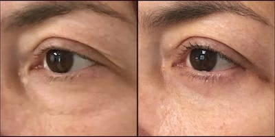 Lower Blepharoplasty Before & After Gallery - Patient 53591869 - Image 1