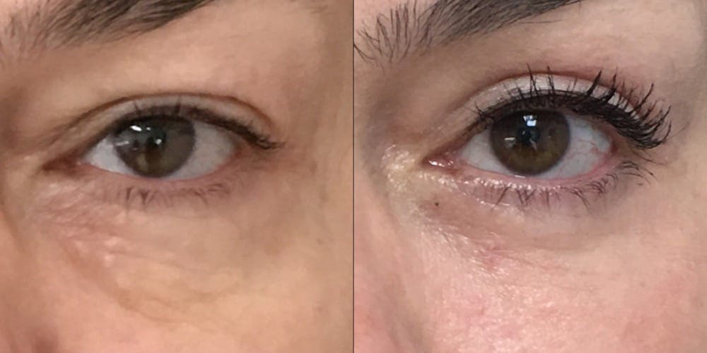 Lower Blepharoplasty Before & After Gallery - Patient 53591872 - Image 2