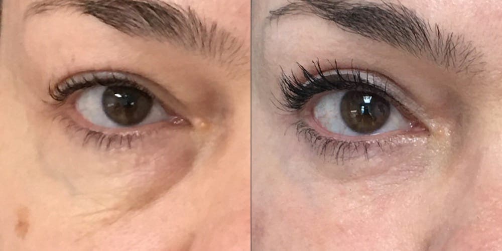 Lower Blepharoplasty Before & After Gallery - Patient 53591872 - Image 1