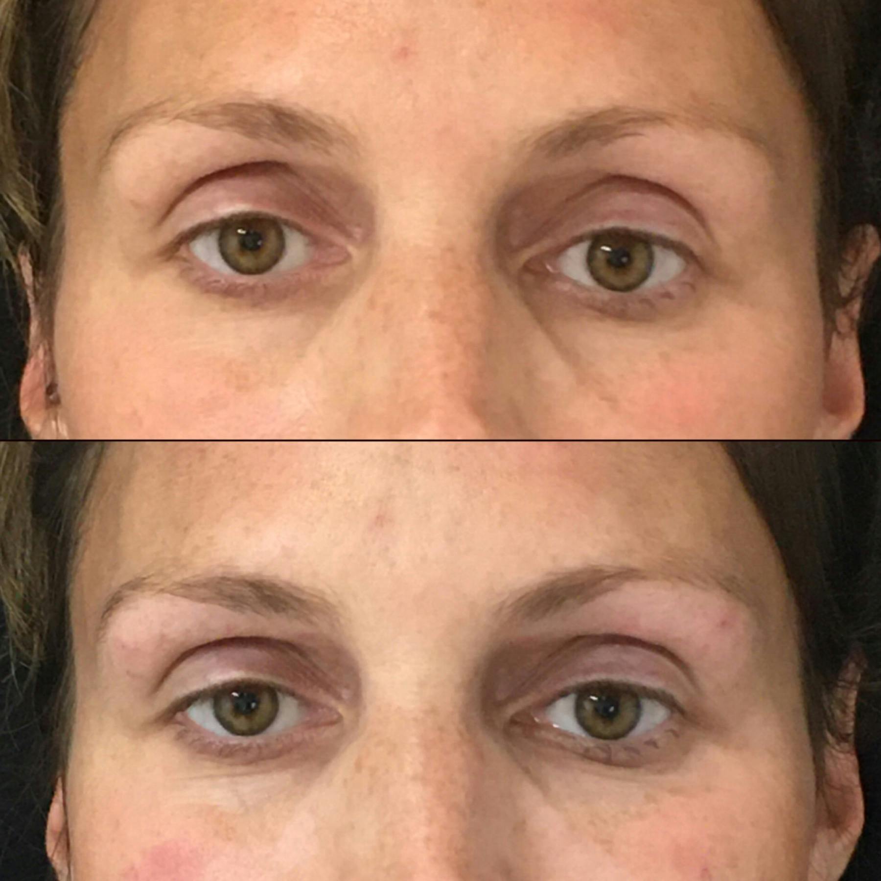 Eyelid Filler Before & After Gallery - Patient 54385408 - Image 1
