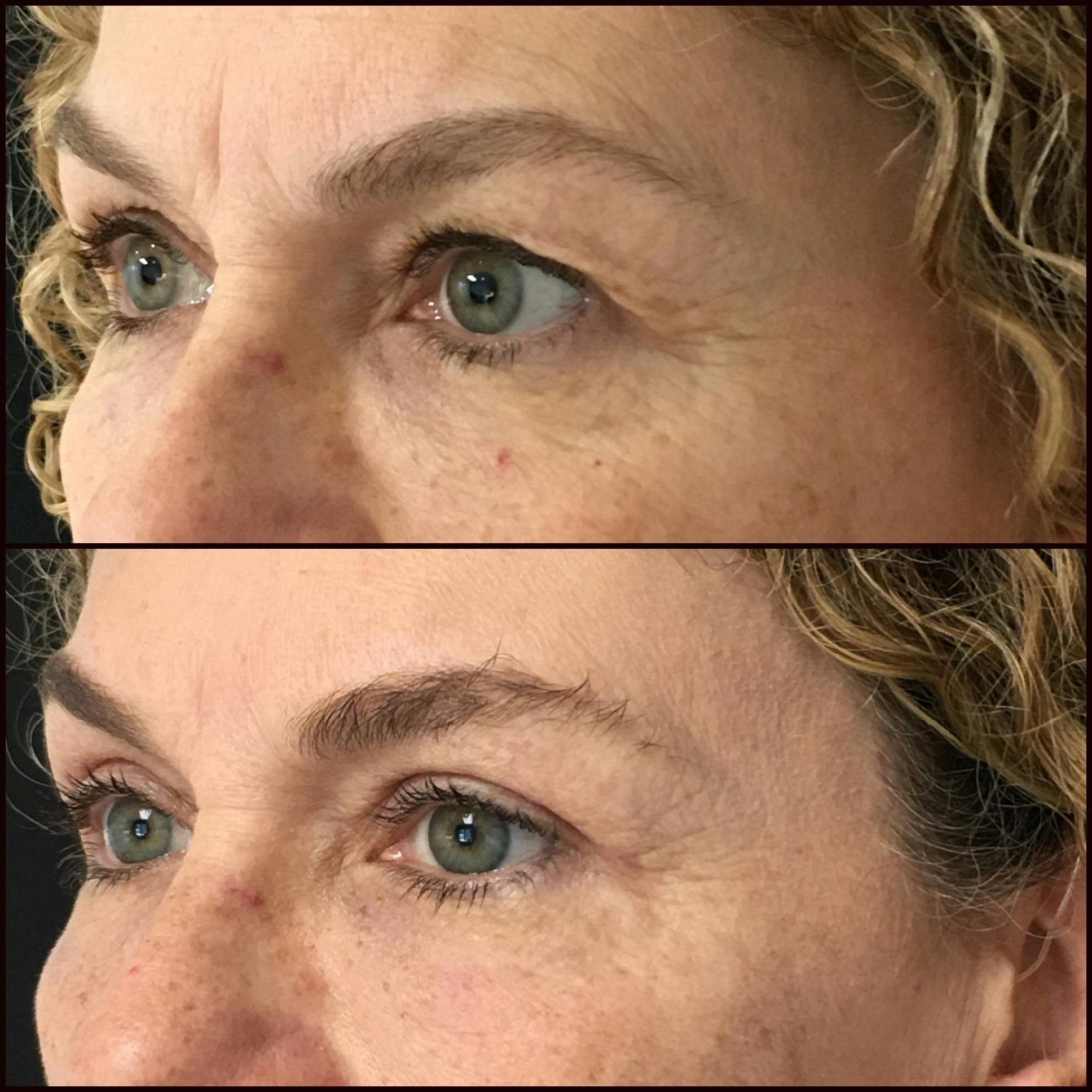 Upper Blepharoplasty Before & After Gallery - Patient 54385465 - Image 2