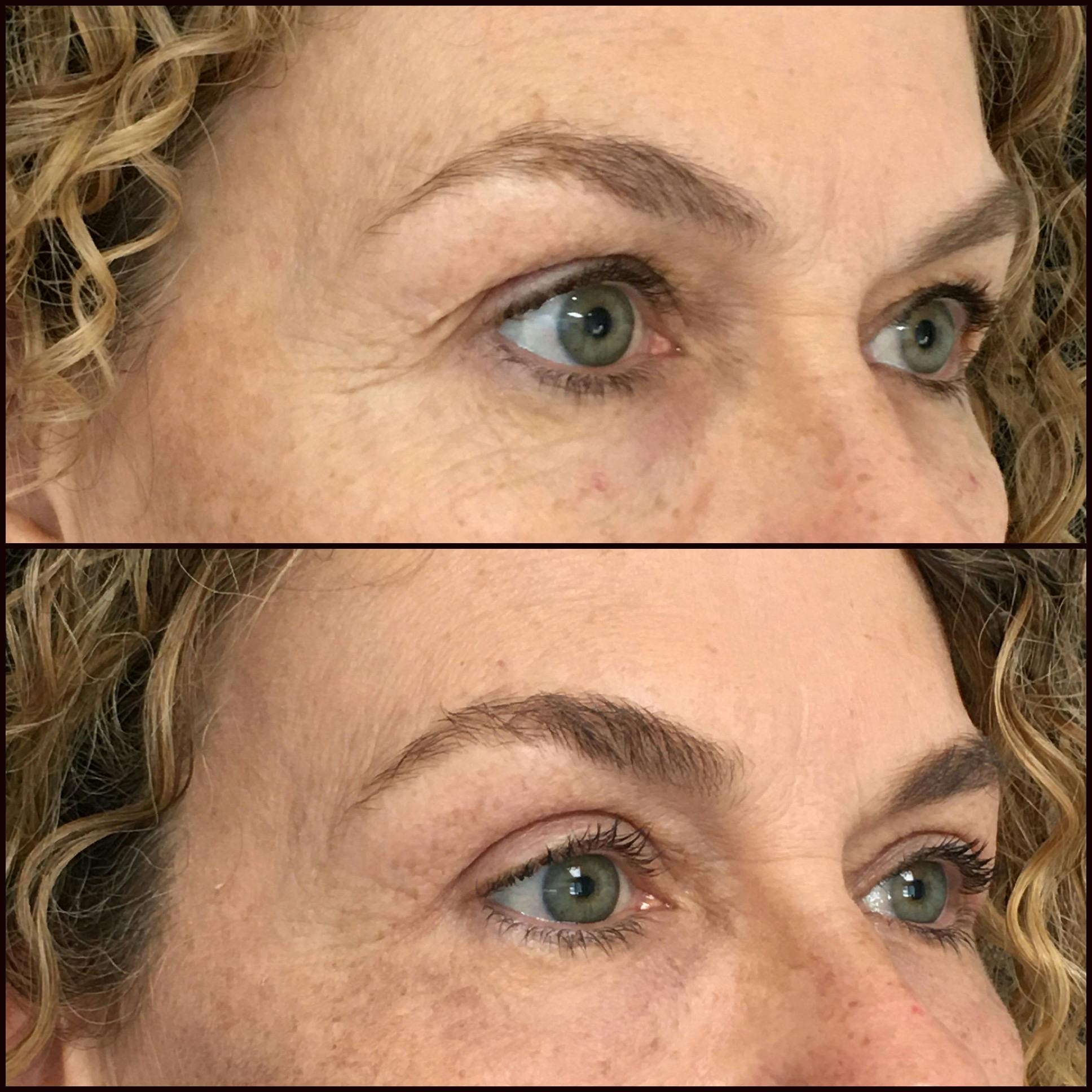 Upper Blepharoplasty Before & After Gallery - Patient 54385465 - Image 1