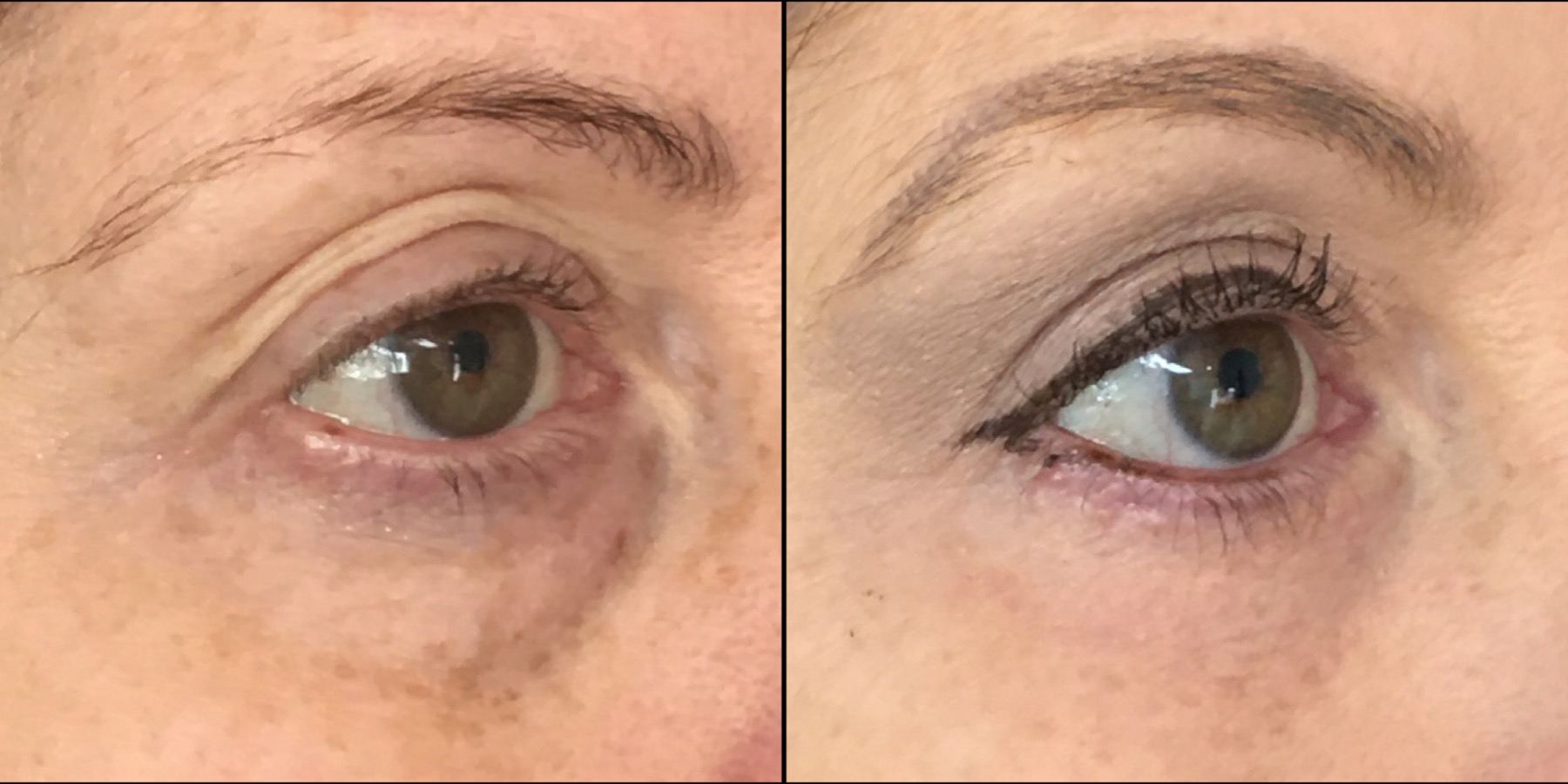 Patient 53591725 | Upper Blepharoplasty Before & After Photos | Flora Levin  MD