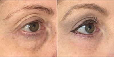 Upper Blepharoplasty Before & After Gallery - Patient 53591725 - Image 1