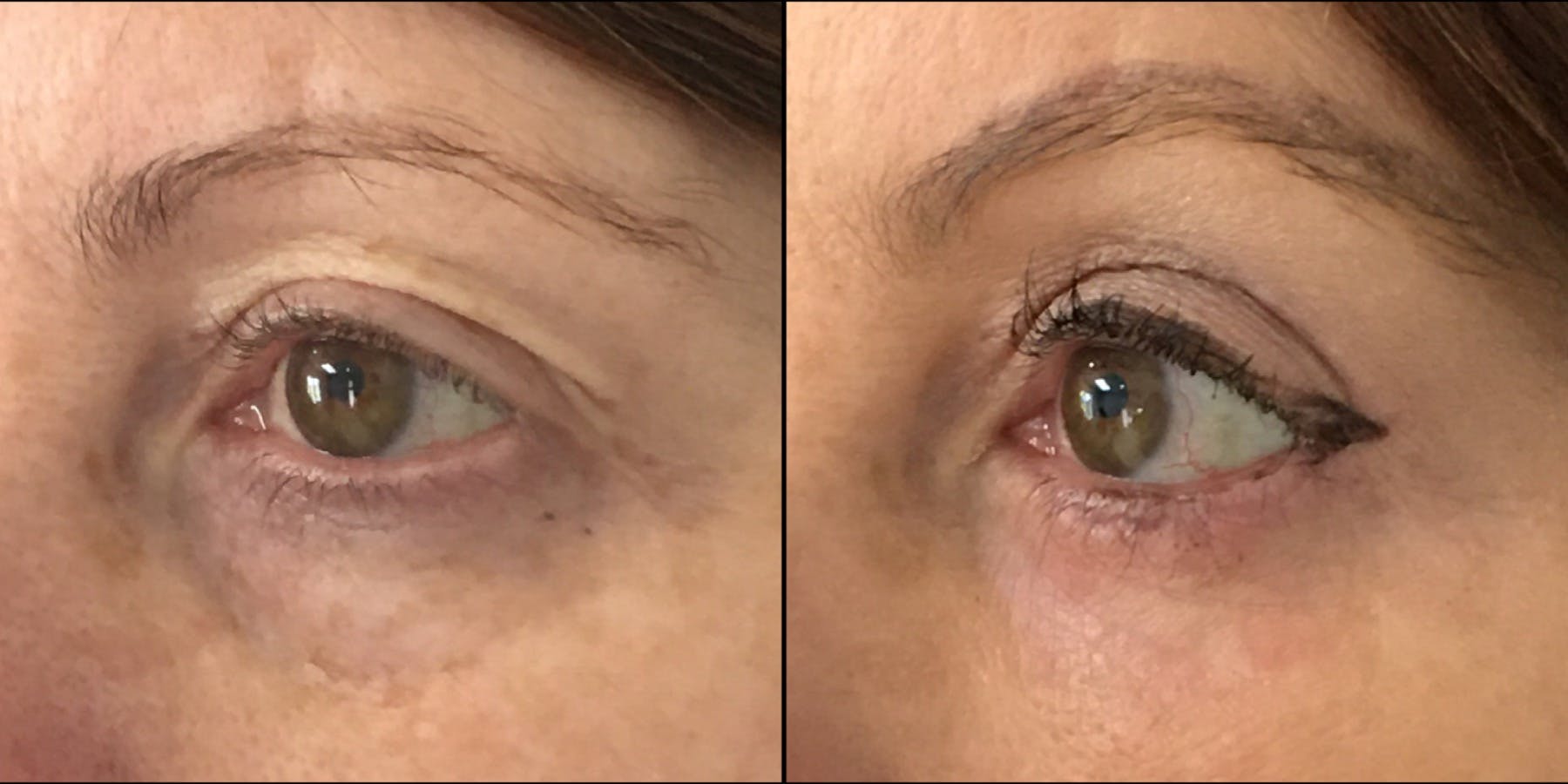Upper Blepharoplasty Before & After Gallery - Patient 53591725 - Image 2