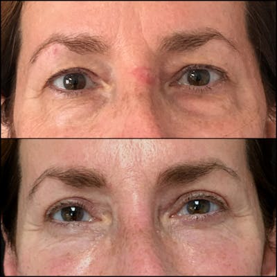 Upper Blepharoplasty Before & After Gallery - Patient 54385581 - Image 1