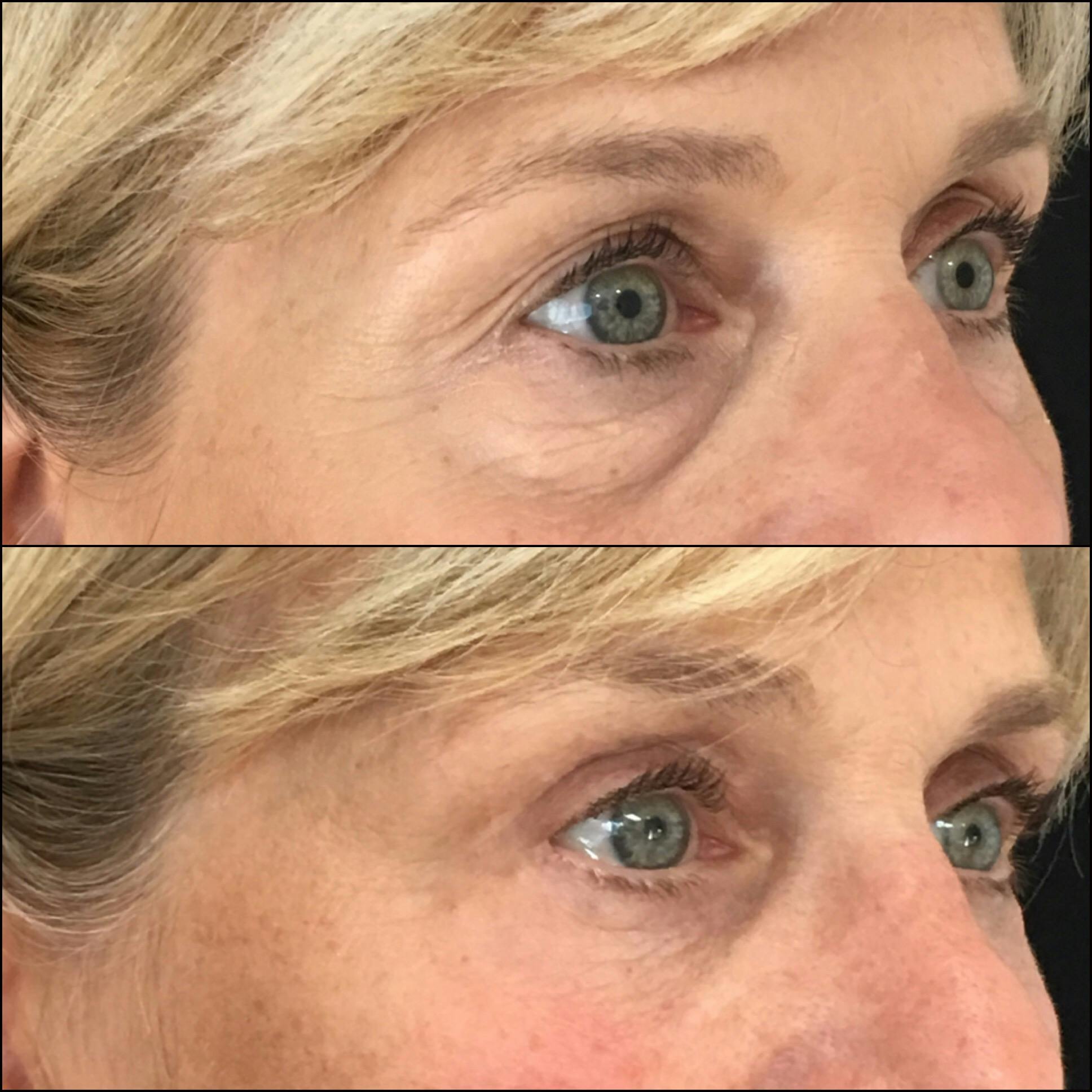 Upper Blepharoplasty Before & After Gallery - Patient 54385580 - Image 1