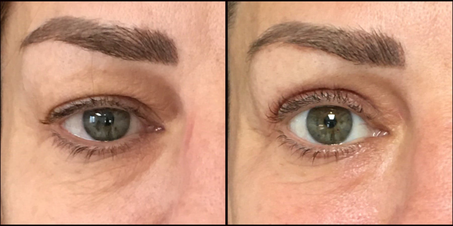Upper Blepharoplasty Before & After Gallery - Patient 53591726 - Image 1
