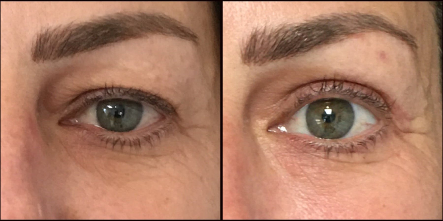 Upper Blepharoplasty Before & After Gallery - Patient 53591726 - Image 2