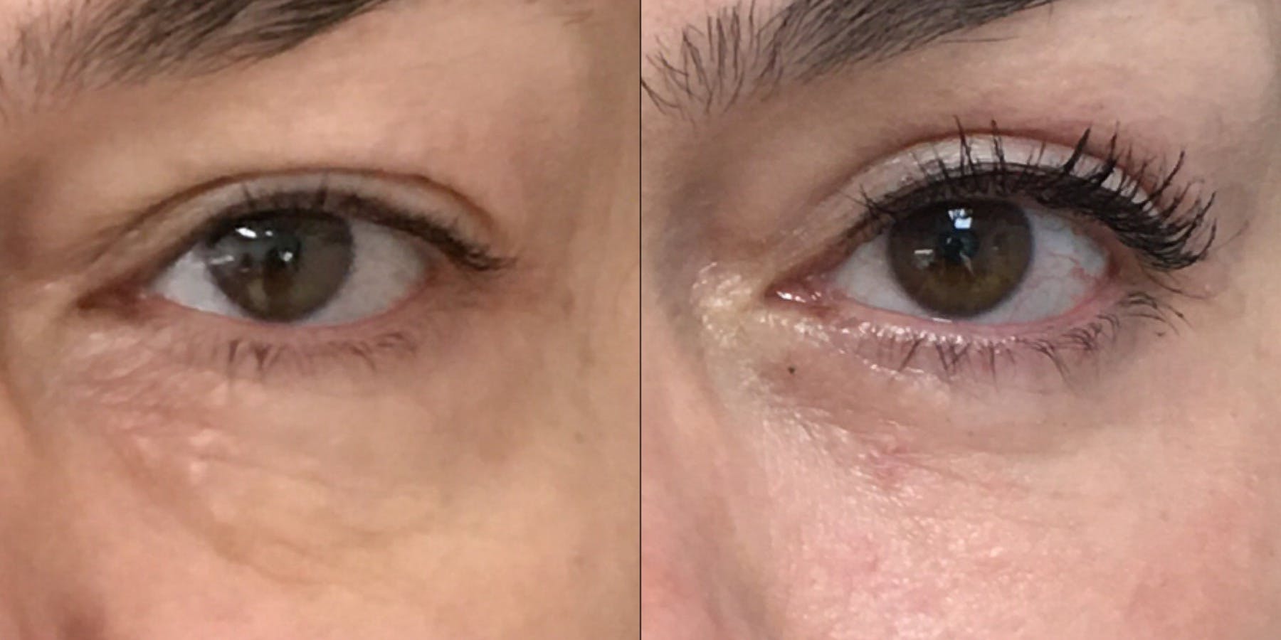 Upper & Lower Blepharoplasty Before & After Gallery - Patient 53819407 - Image 2
