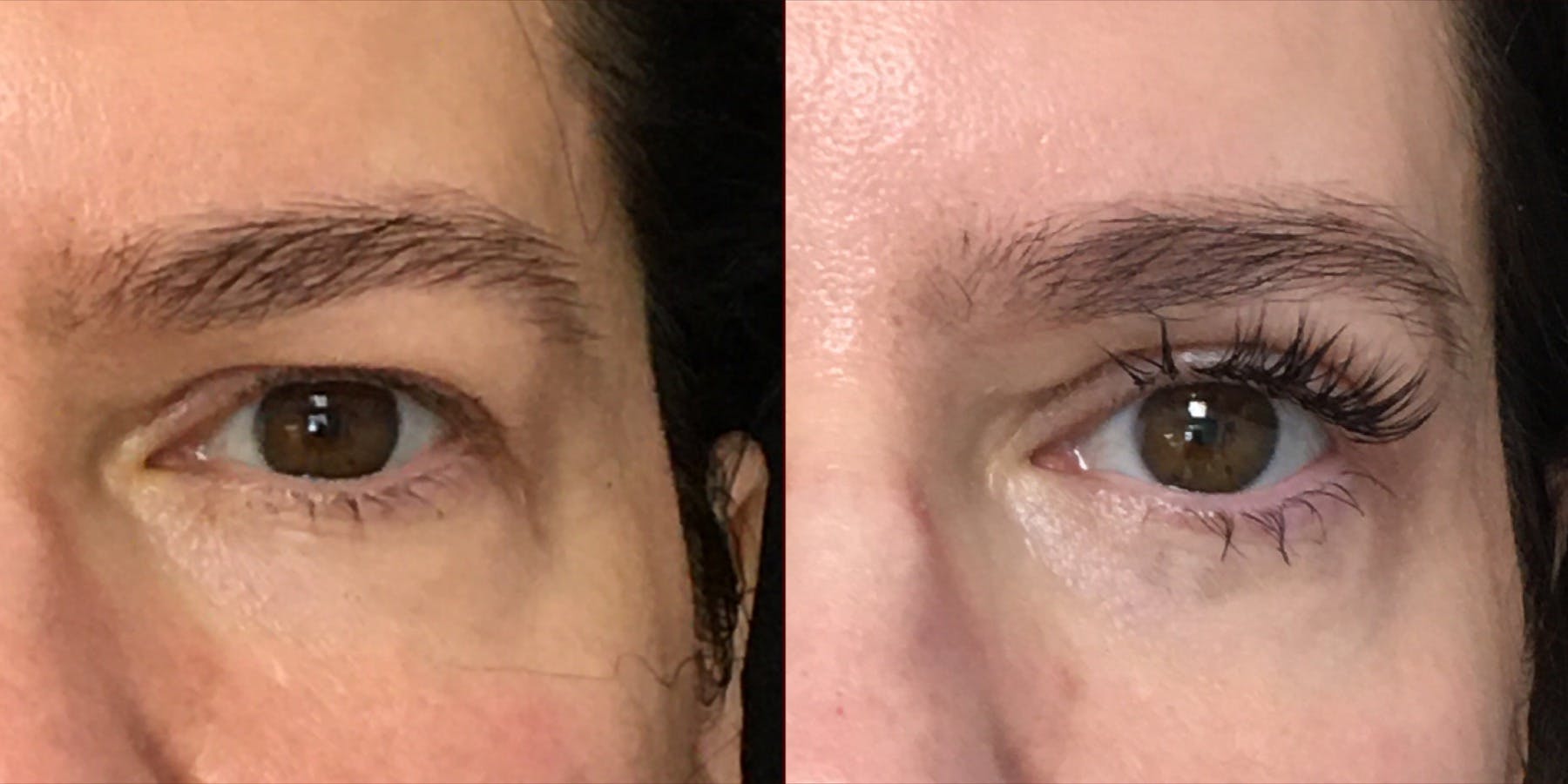 Upper Blepharoplasty Before & After Gallery - Patient 54385624 - Image 2