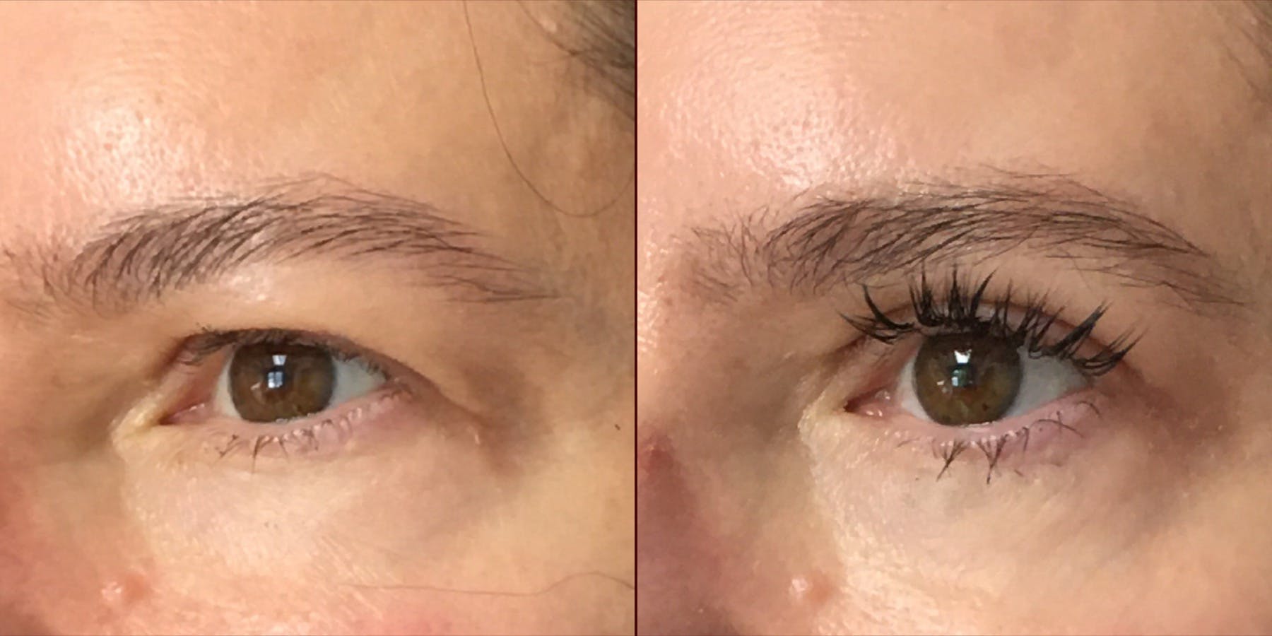 Upper Blepharoplasty Before & After Gallery - Patient 54385624 - Image 3