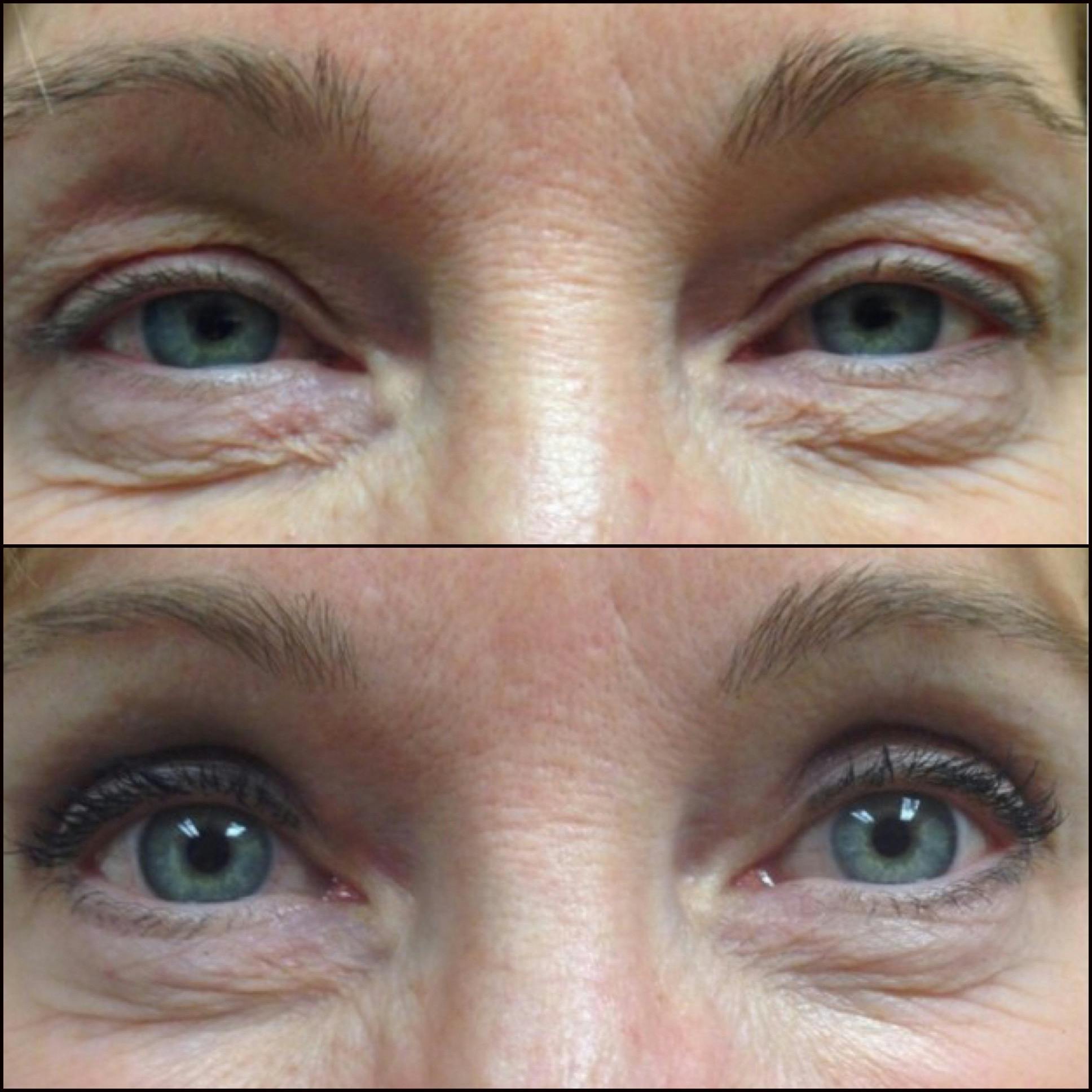Upper Blepharoplasty Before & After Gallery - Patient 54385584 - Image 1