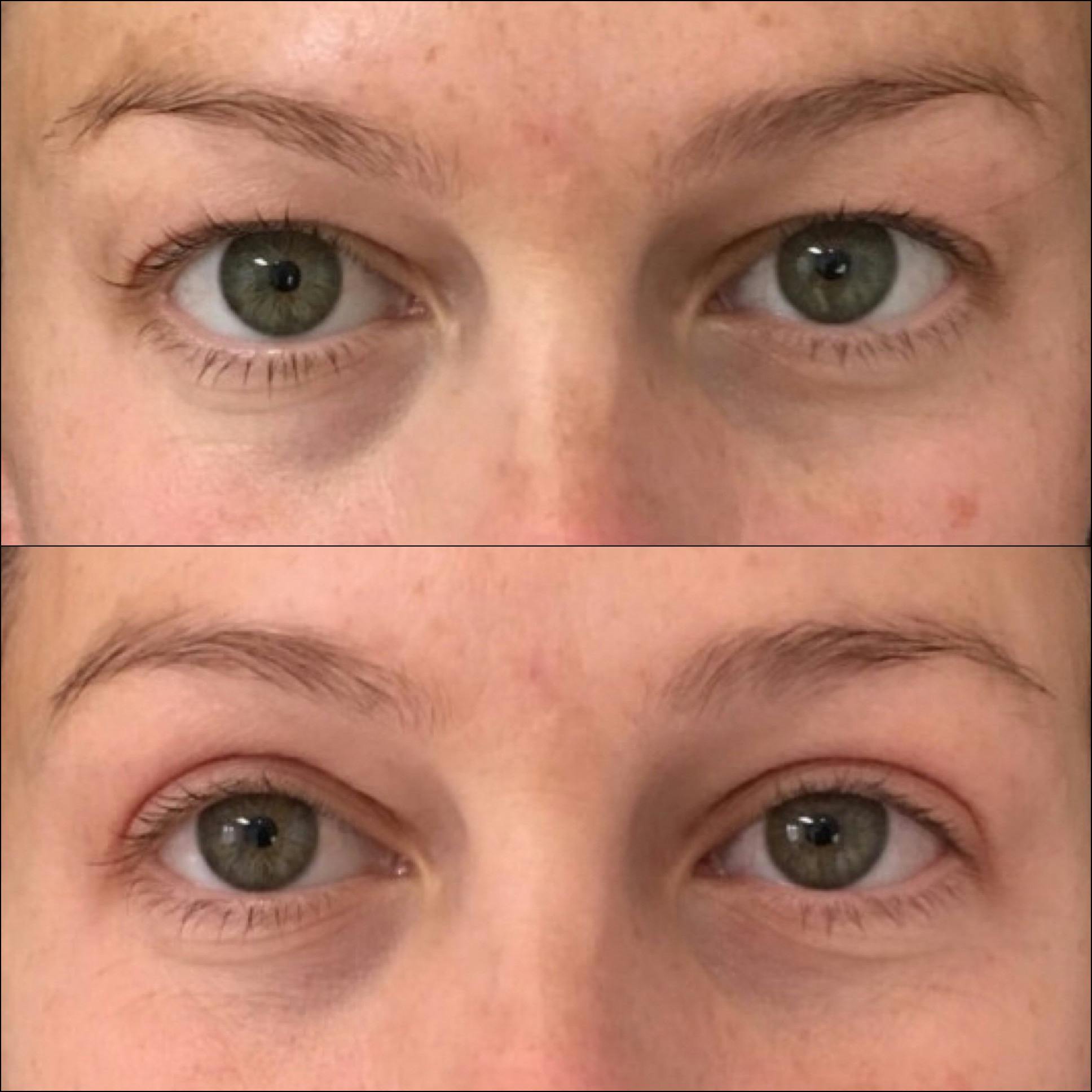 Upper Blepharoplasty Before & After Gallery - Patient 54385585 - Image 1