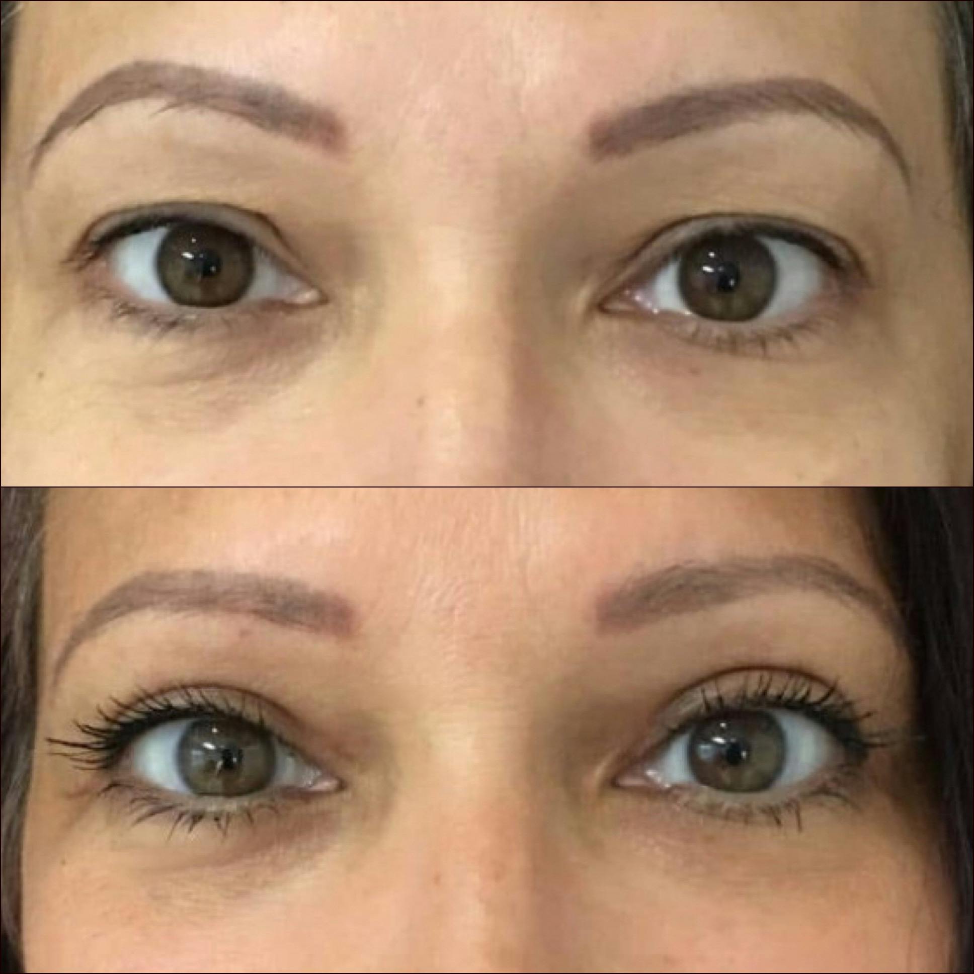 Upper Blepharoplasty Before & After Gallery - Patient 54385587 - Image 1