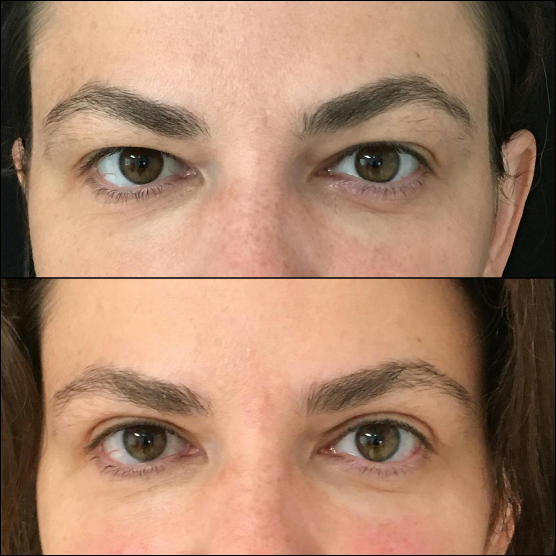 Upper Blepharoplasty