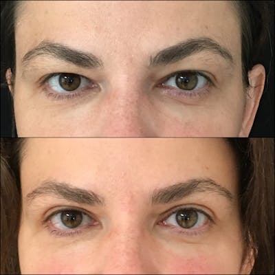 Upper Blepharoplasty Before & After Gallery - Patient 54385588 - Image 1