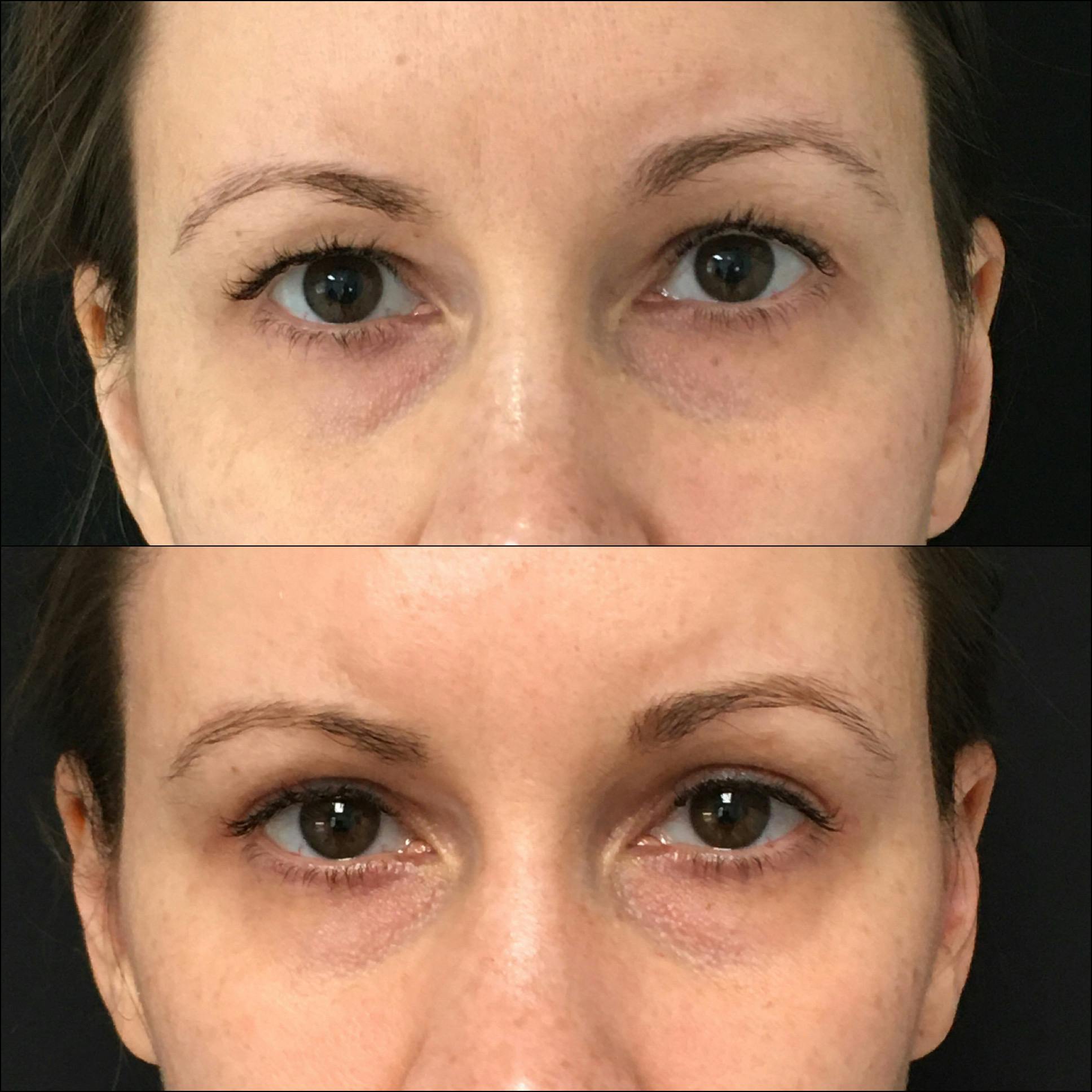 Upper Blepharoplasty Before & After Gallery - Patient 54385606 - Image 1