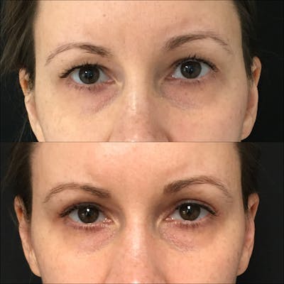 Upper Blepharoplasty Before & After Gallery - Patient 54385606 - Image 1
