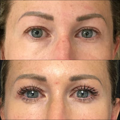 Upper Blepharoplasty Before & After Gallery - Patient 54385607 - Image 1