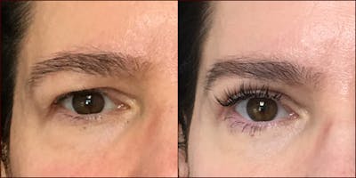 Upper Blepharoplasty Before & After Gallery - Patient 54385624 - Image 1